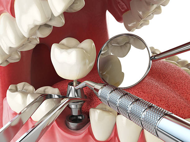 Best Knocked-Out Tooth (Avulsed Tooth) Treatment in Willmsburg, IA